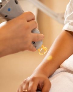 laser hair removal